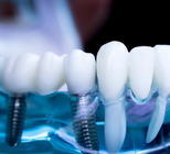 פרי אימפלנטיטיס - תמונת המחשה